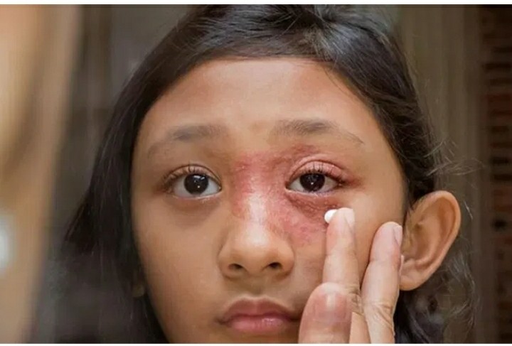 Came New disease is 'black fungus', which forces the eyes to get out!